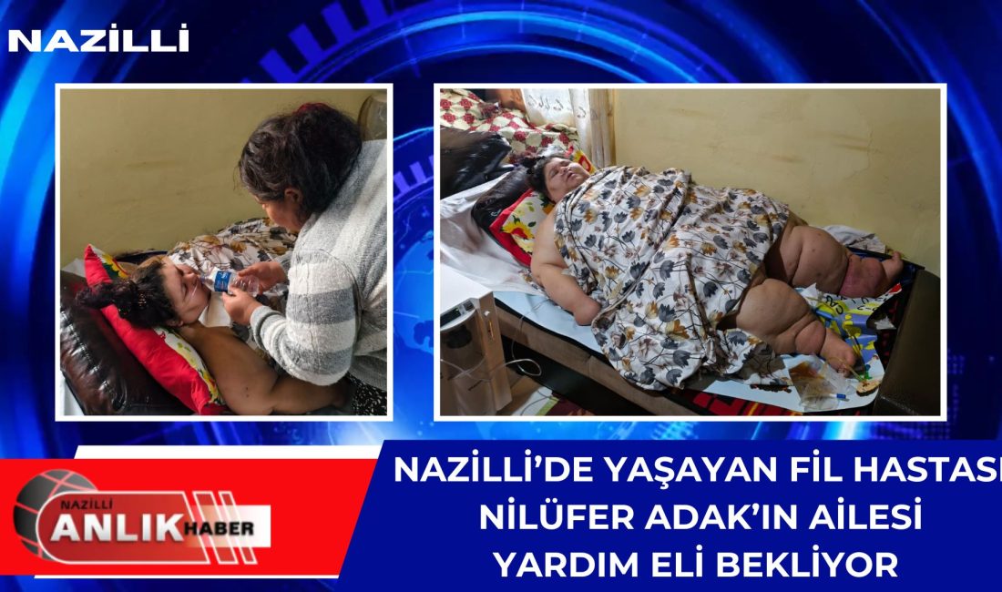 ÖZEL HABER – Aydın’ın Nazilli ilçesinde, doğuştan “Fil Hastalığı” (Lenfödem)