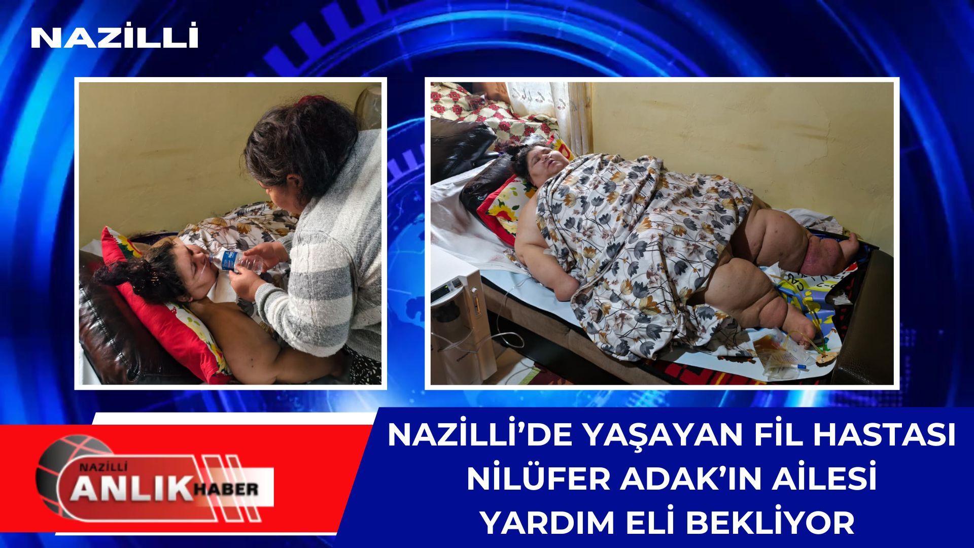 ÖZEL HABER – Aydın’ın Nazilli ilçesinde, doğuştan “Fil Hastalığı” (Lenfödem)